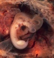 562px-Tubal Pregnancy with embryo.jpg